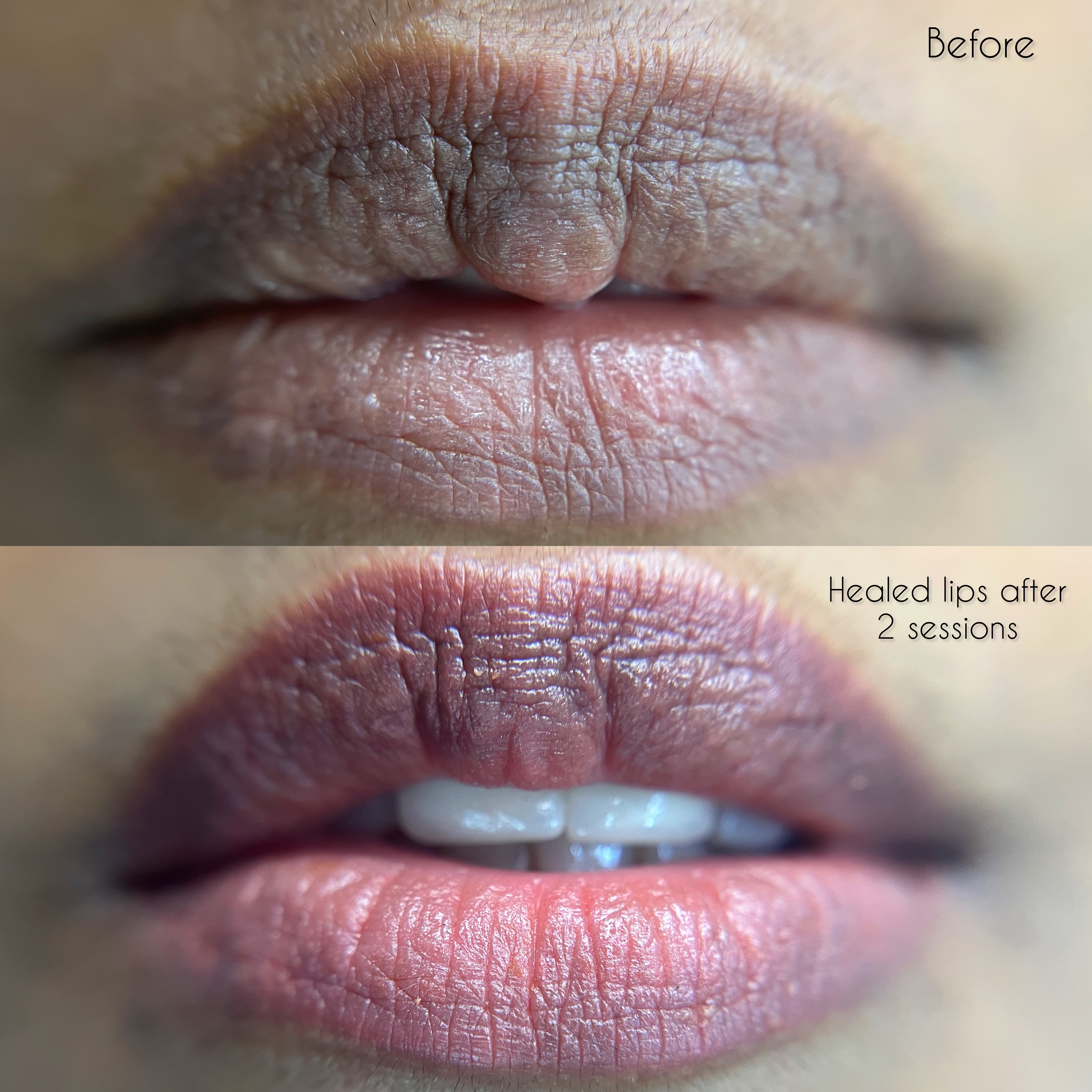 Lips Transformation